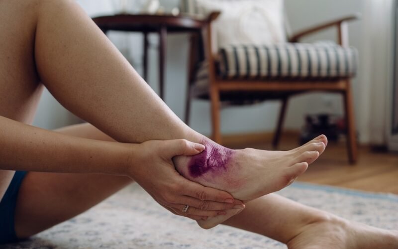 How to Heal a Sprained Ankle Overnight​​​
