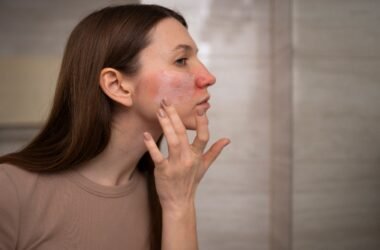 Monsoon Acne Myths Vs. Facts