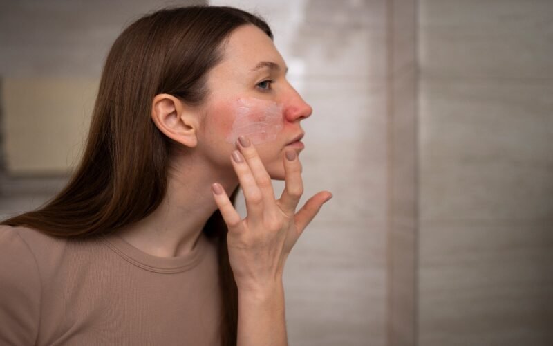 Monsoon Acne Myths vs. Facts