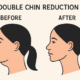 Reducing Double Chin